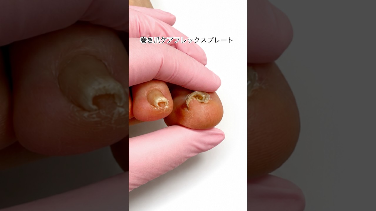 クルンと巻いた巻き爪ケア フレックスプレート