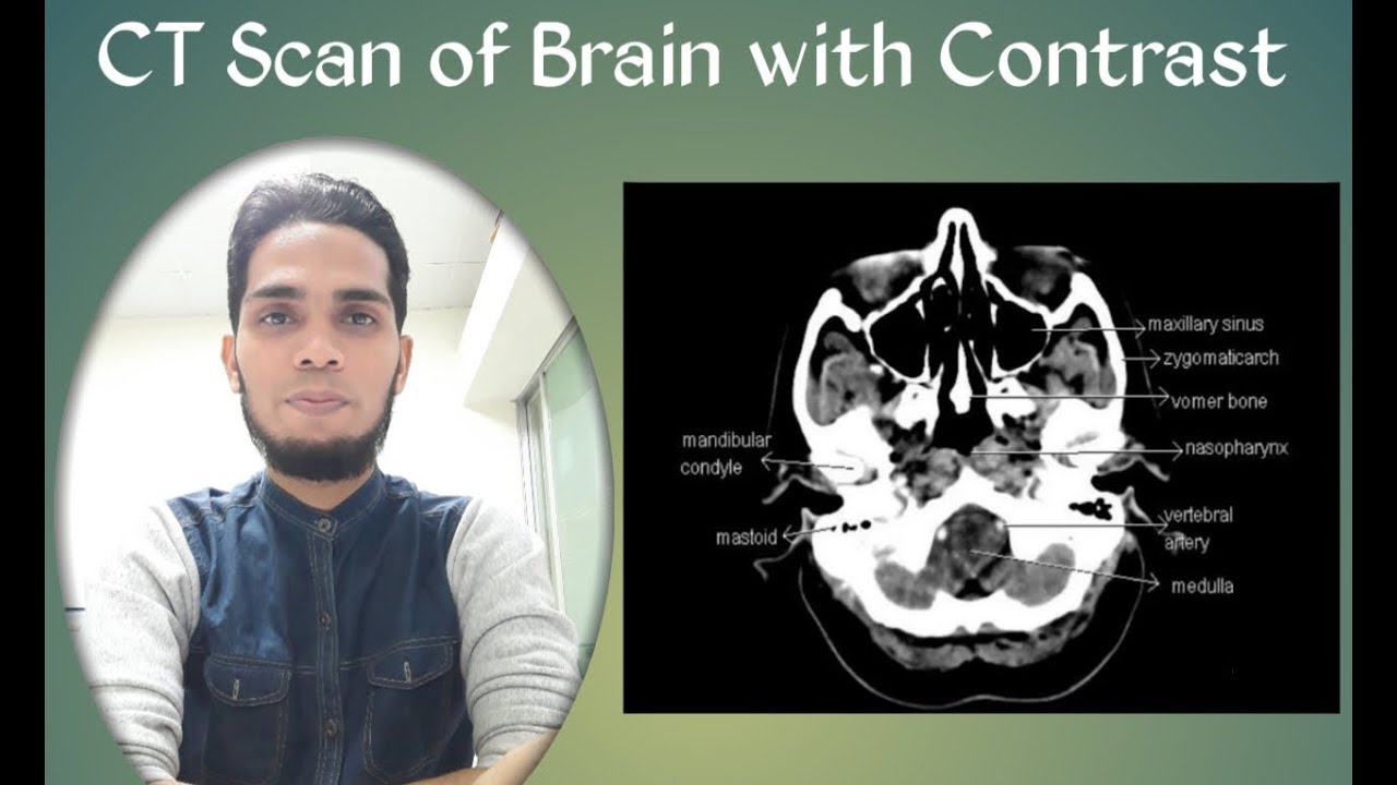 CT scan of brain with contrast axial filming study - YouTube