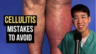 How to Treat Cellulitis (Common Mistakes to Avoid)