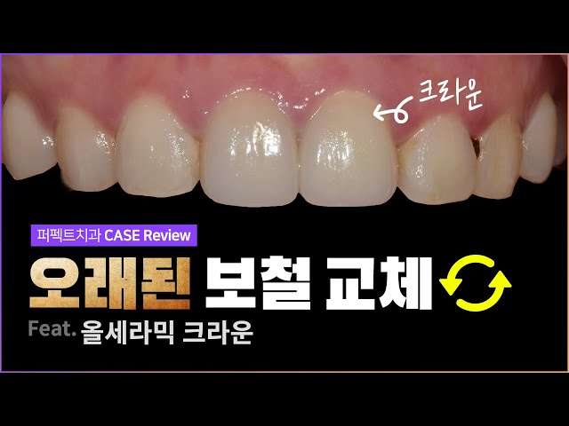 오래된 앞니 크라운 교체🦷🔄 | 올세라믹크라운, 폴리네이트
