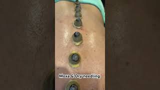 Moxibustion combined with Dry Needling supports holistic healing of mind body and soul
