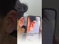 Ear Correction at Cici Beauty #filler #fillerhanoi #cicibeauty
