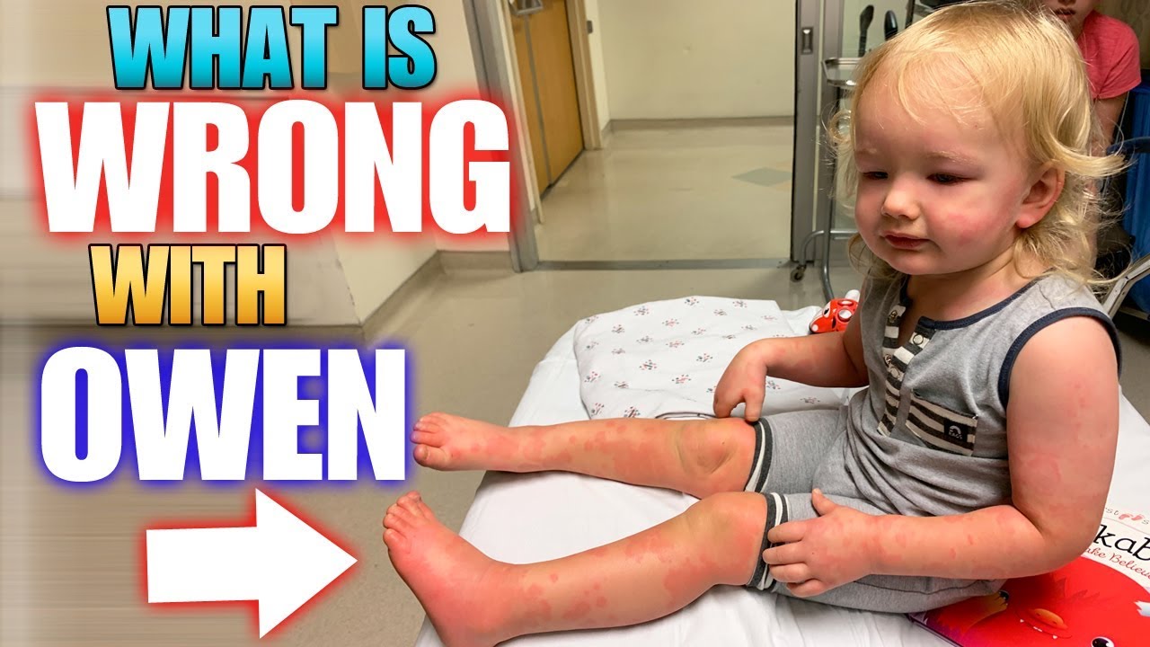 Owen Super Swollen - Sudden Allergic Reaction!!