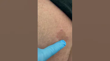 حالة التهاب فطرى للجلد حزاز Ringworm 