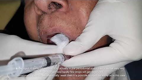 intraligamentary local anaesthesia technique by using conventional syringe by dr nishit kumar shah .