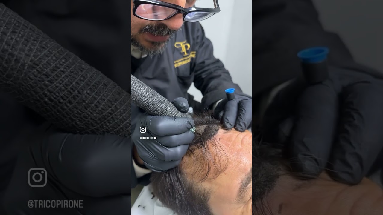 Trico effetto densità per capelli diradati o densificare il tuo trapianto per info:3453177804