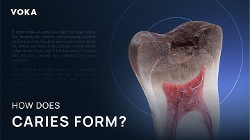 How tooth decay develops: a 3D visual guide to cavity formation