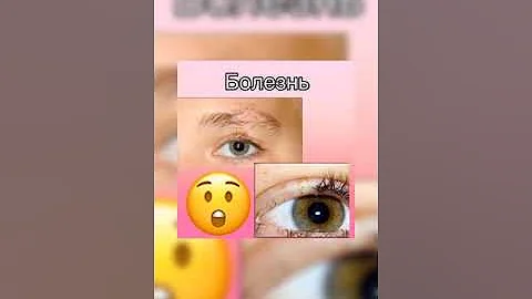 Выдергивание ресниц и бровей