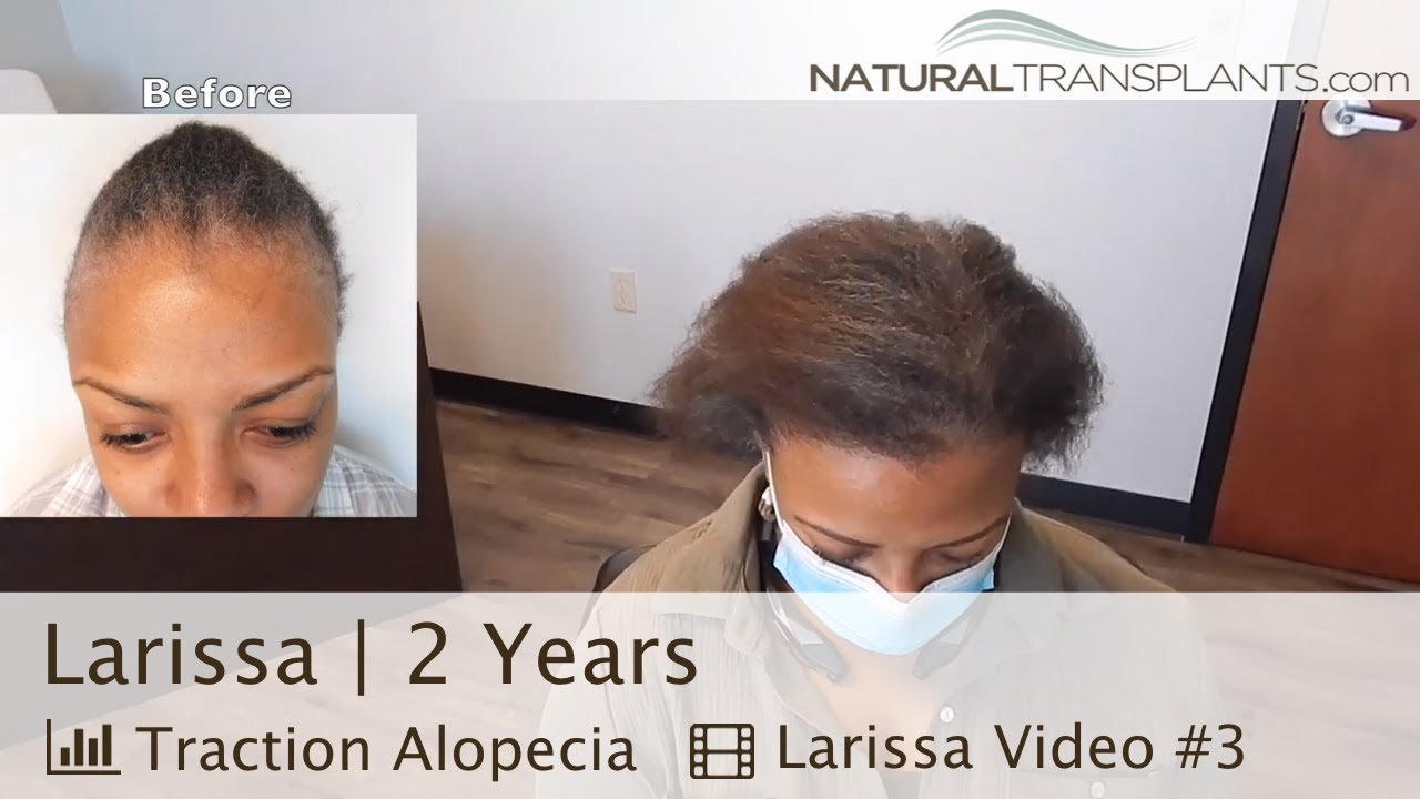 2 Year Hair Transplant Results with Natural Transplants | Dr. Matt Huebner (Larissa)
