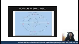 Visual Field Defects in Glaucoma || Dr. Niha Aggarwal