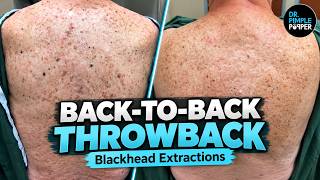 Back to Back Throwback | Fan Favorite Blackhead Extractions | Dr. Pimple Popper