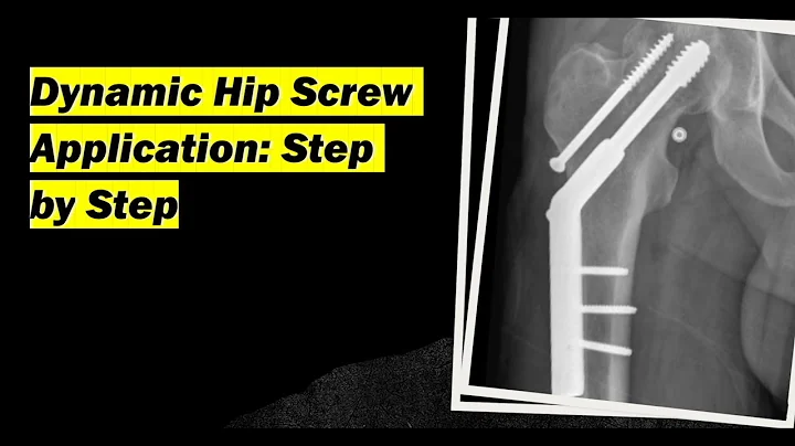 DHS (dynamic hip screw) All Basic steps