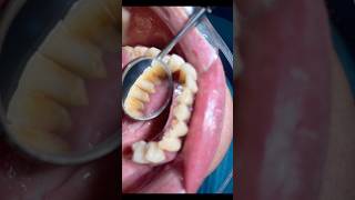 Inflamed gums scaling 😱 before and after #shorts