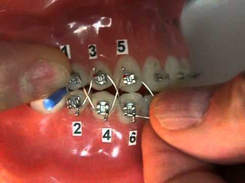 Orthodontic Jaw Wiring in the Dental Professional Office - YouTube