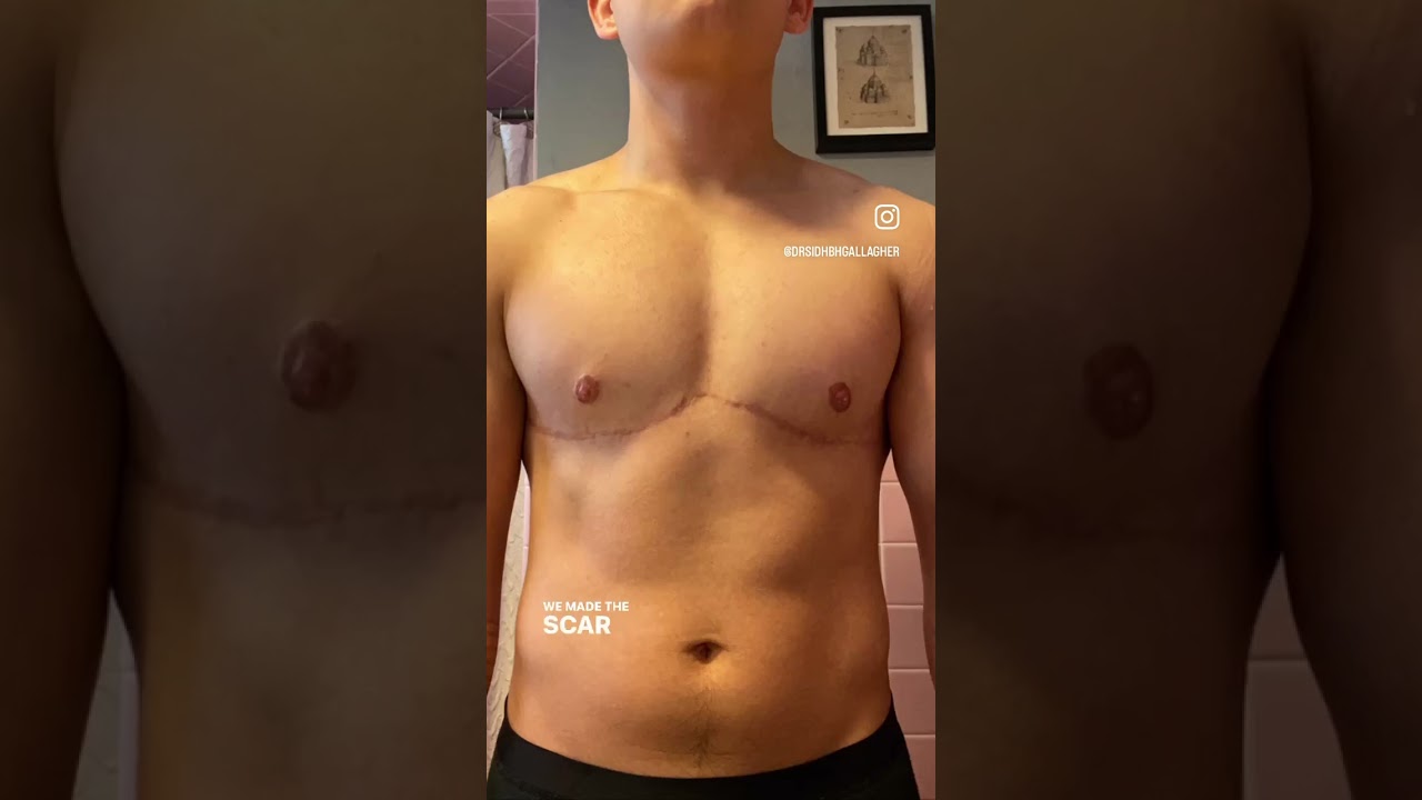 Early result from drain free top surgery with Dr. G