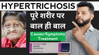 अनचाहे बाल आने का कारण और इलाज | Hypertrichosis Causes, Symptoms And Treatment