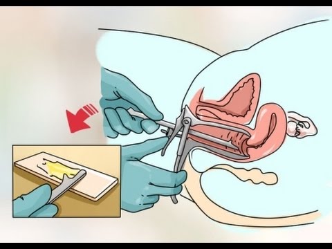 Las causas más comunes de una citología vaginal anormal papiloma humano