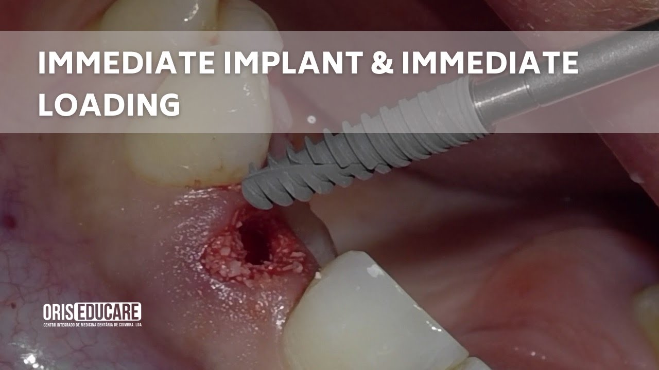 Immediate Implant Placement and Immediate Loading - YouTube