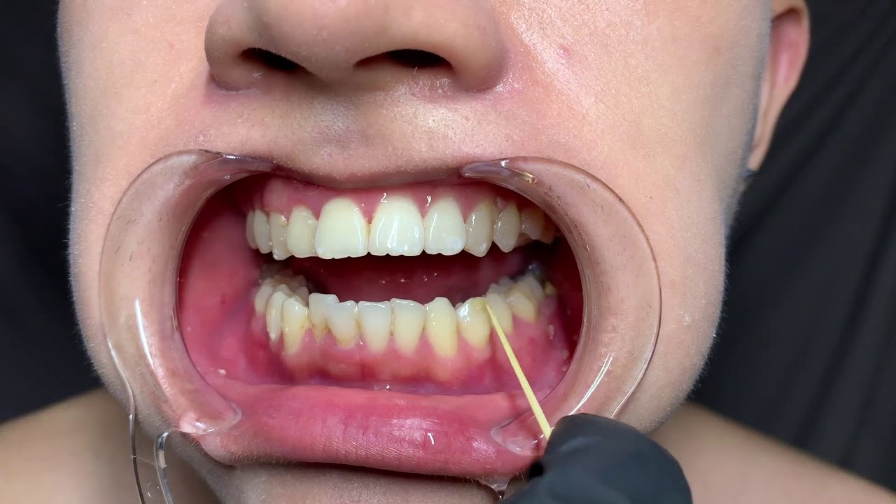 Stimulus Tooth Stimulus Project Part 2 Ticking Teeth - YouTube