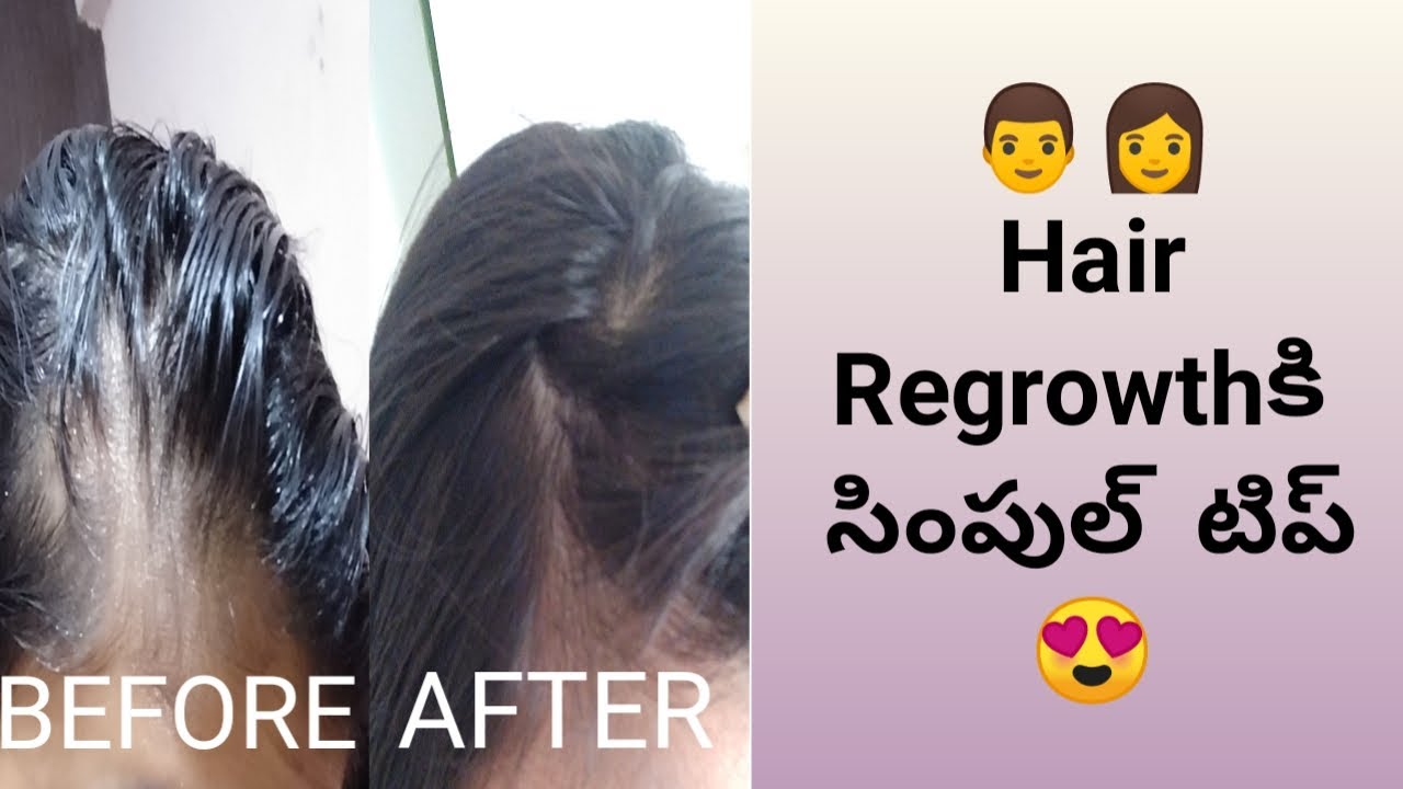 Simple way to make your hair Regrow జుట్టు తిరిగి పెరగటానికి సింపుల్