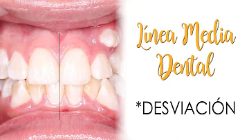 ¿Por qué se me desalinean los dientes?