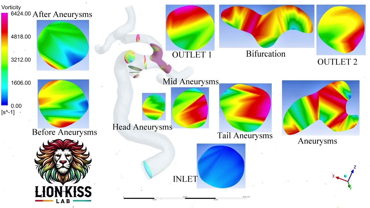 Vorticity Flow Dynamics in Cardiac Cycle and Intracranial Aneurysm | 4D Flow Visualization