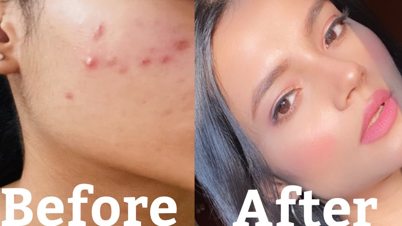 How I cleared My acne In 30 days Cure Acne and pimples Best Face