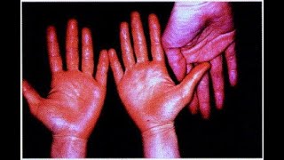 Vitamin A Toxicity Symptoms