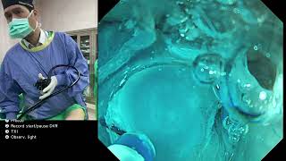 lower rectum/dentate line ESD