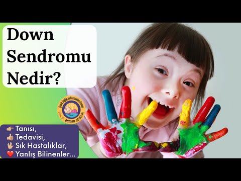 Down Sendromu Nedir? (Sebebi, Risk Faktörleri, Tanı, Tedavi, İzlem...)