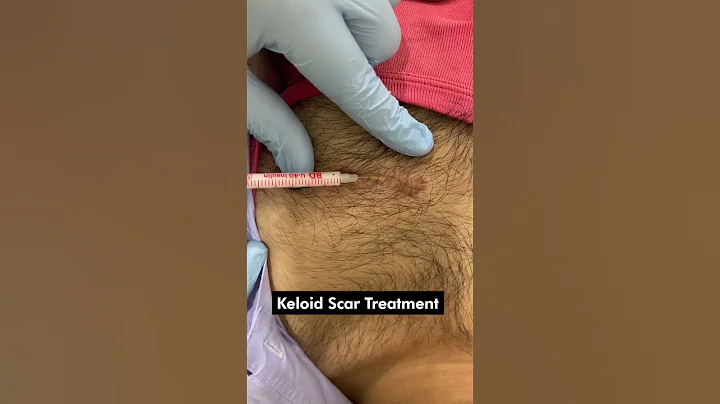 Effective Keloid Scar Treatment Injection | Keloid Removal Treatment | Skinaa Clinic #viral #short - DayDayNews