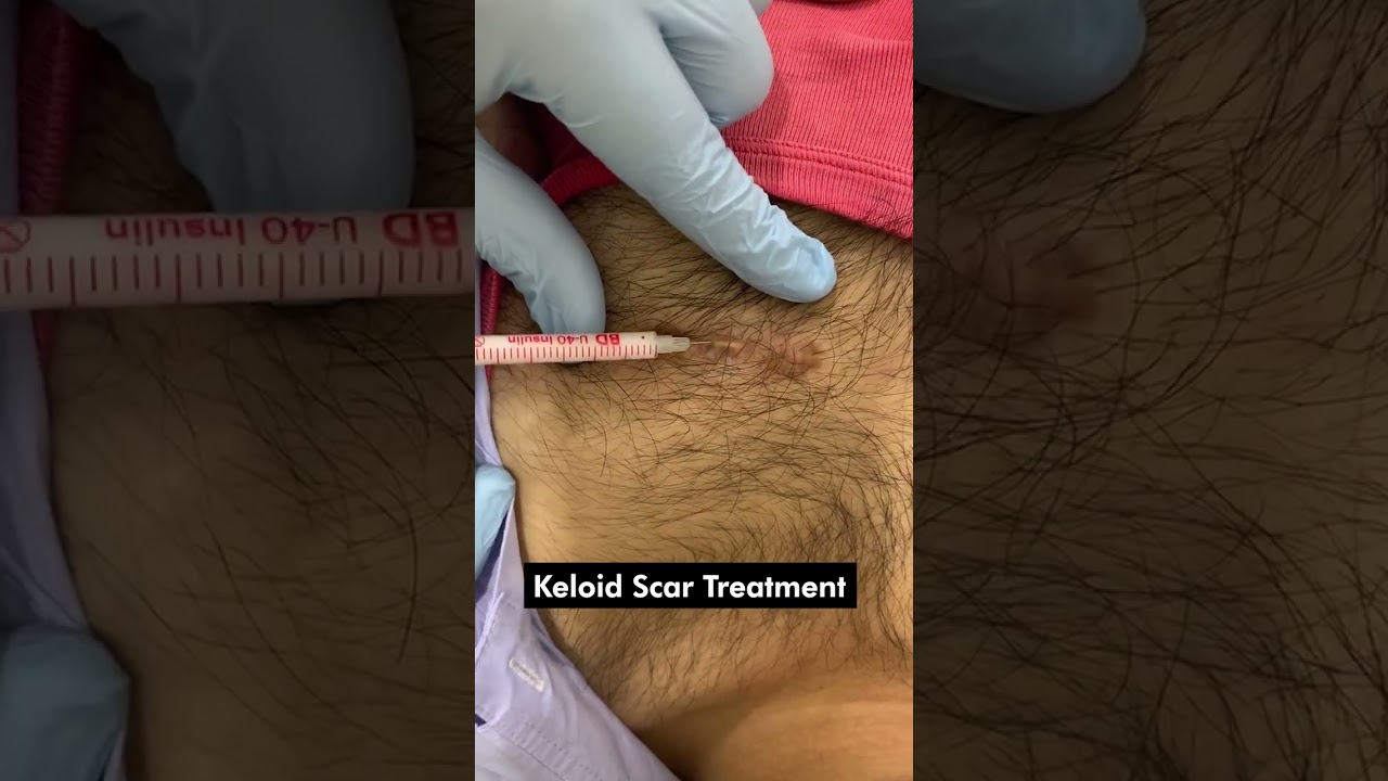 Effective Keloid Scar Treatment Injection | Keloid Removal Treatment | Skinaa Clinic #viral #short