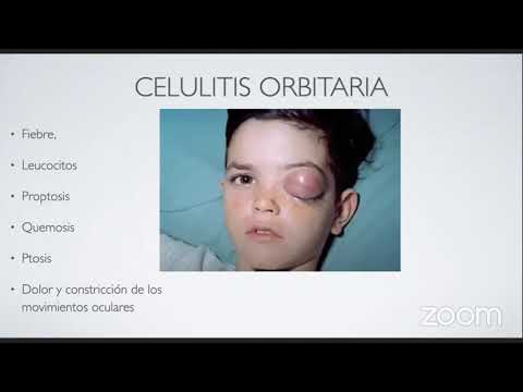 Video: ¿La celulitis periorbitaria es una emergencia?