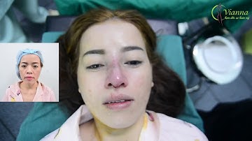 Nâng Mũi Cấu Trúc tại Vianna