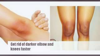 Lighten Dark elbows and knees faster & naturally |  How to get rid of darker knees and elbows faster screenshot 4