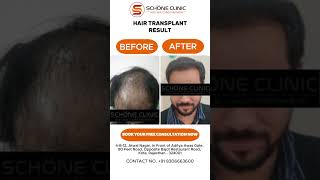 Hair Transplant Result In Kota