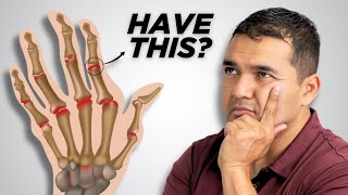 The Way To Stop Hand Arthritis From Getting Worse