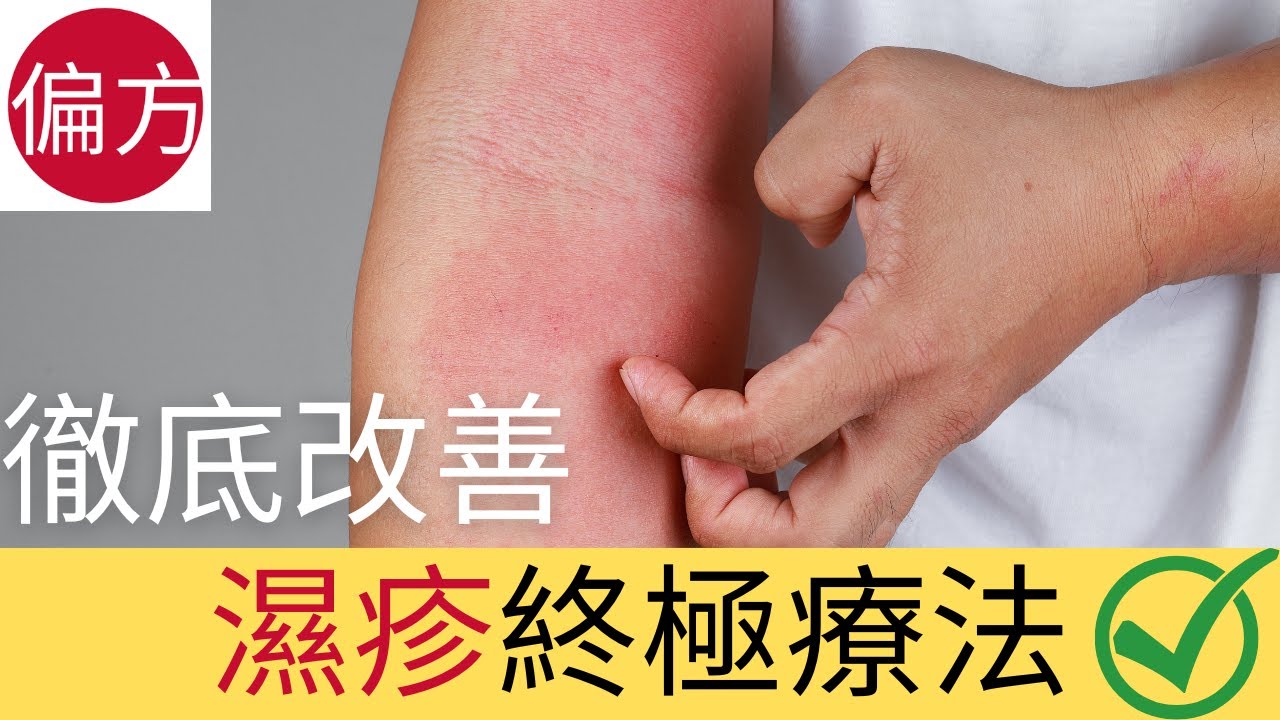 濕疹為何經常復發? 四種方法徹底改善濕疹症狀 - YouTube