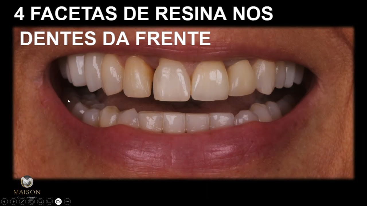 4 Dentes da Frente com Facetas de Resina