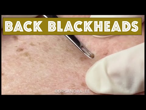 Blackhead Extractions On The Back, Plus...