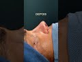 Mais um sonho realizado através da Rinoplastia!
