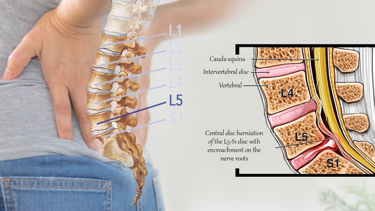 L4L5 Disc Bulge Treatment Acupressure Acupuncture acupressure 