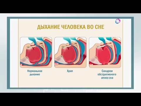 Видео: Апнея в съня при деца: симптоми, причини, лечение и др