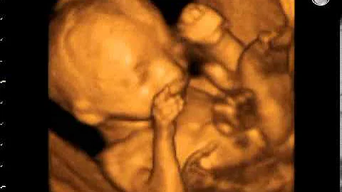 Rotunda - 4D Open your mouth   22 weeks