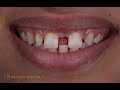 Combined approach for large diastema closure part II