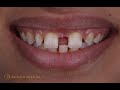 Combined approach for large diastema closure part ii