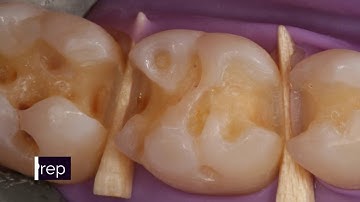 Posterior Composites - The Selective Etch Technique | DOTHANDSON