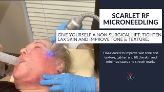 Improve Your Skin with Scarlet SRF