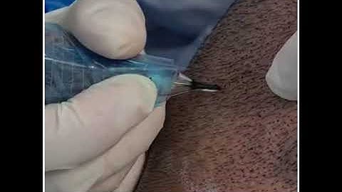 SMP Scalp Micro Pigmentation by El Truchan London @ Scalp Micro Definition