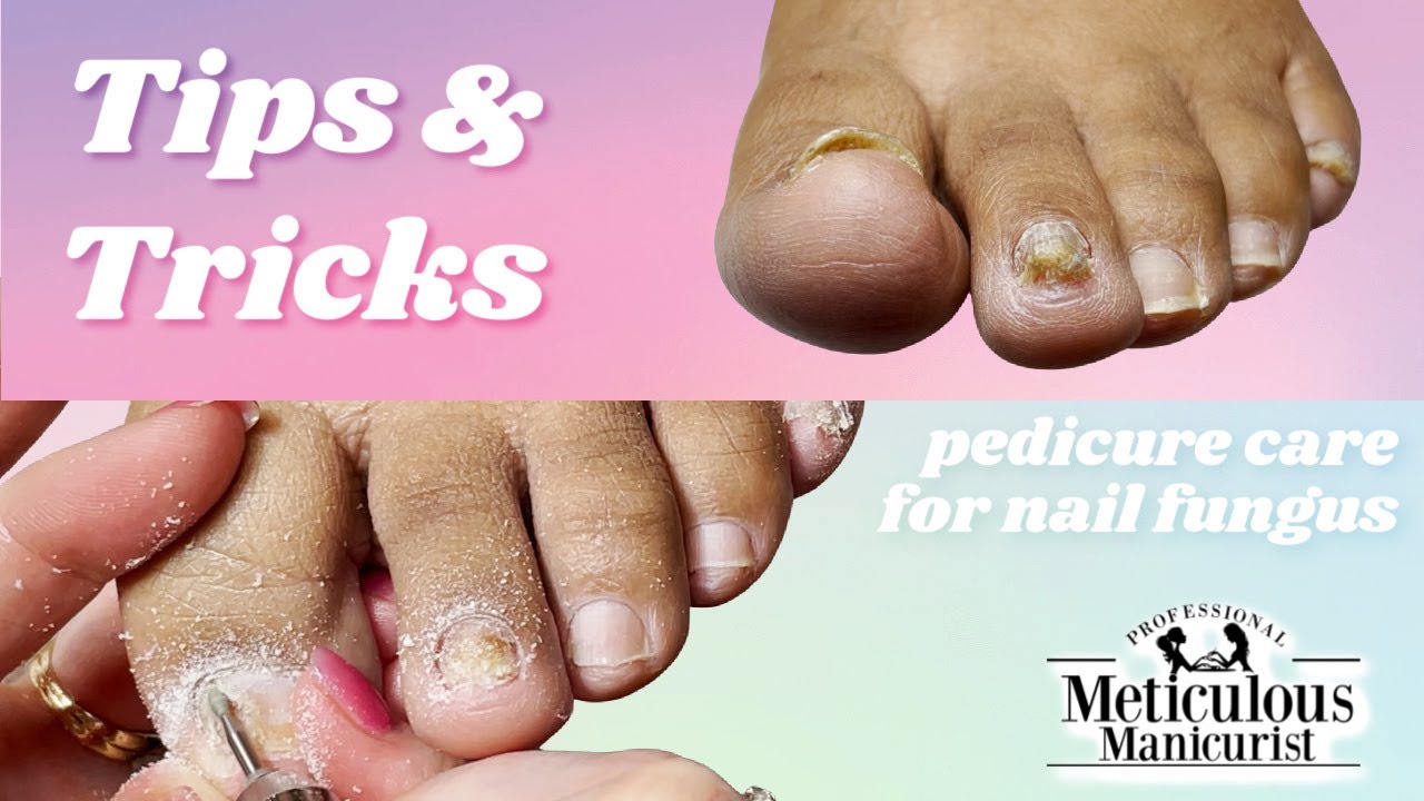 Dealing with thick, discolored toenails - Harvard Health